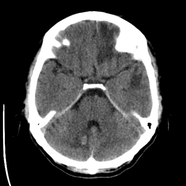 Brain metastases from lung cancer (Radiopaedia 24480-24781 Axial non-contrast 13).jpg