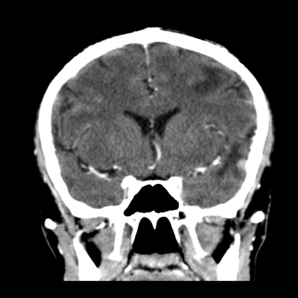 Brain metastases from lung cancer (Radiopaedia 24480-24781 Coronal C+ delayed 24).jpg