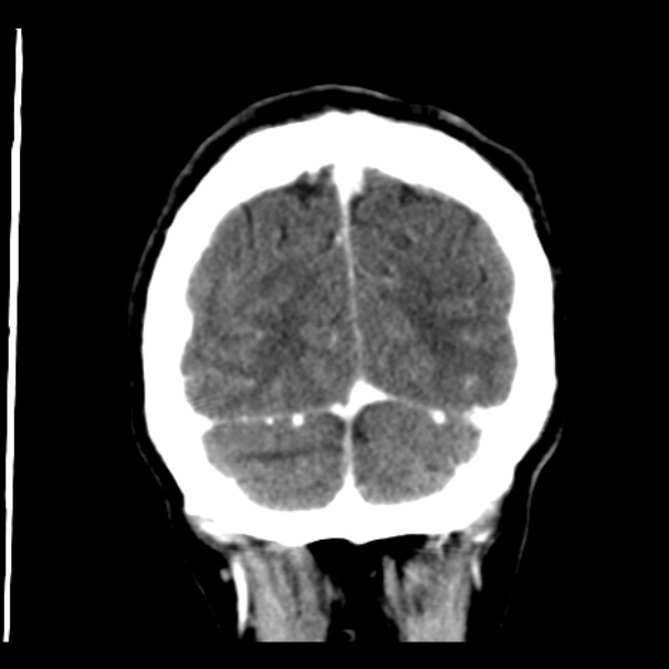 Brain metastases from lung cancer (Radiopaedia 24480-24781 Coronal C+ delayed 55).jpg