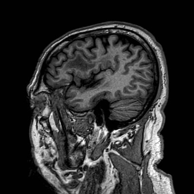 Brain metastases from lung cancer (Radiopaedia 83839-99028 Sagittal T1 24).jpg