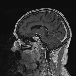 Brain metastasis (Radiopaedia 42617-45761 Sagittal T1 C+ 43).jpg