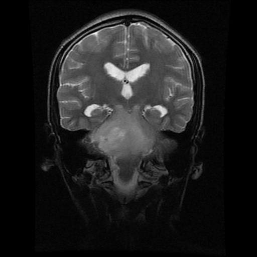 File:Brainstem glioma (Radiopaedia 30923-31624 Coronal T2 9).jpg