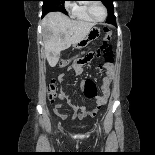 File:Breast cancer pseudocirrhosis after chemotherapy (Radiopaedia 65407-74456 Coronal 29).jpg