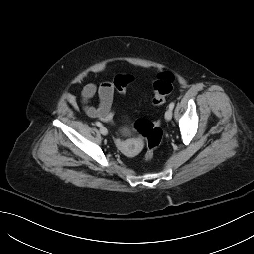 Breast carcinoma with pathological hip fracture (Radiopaedia 60314-67974 B 61).jpg