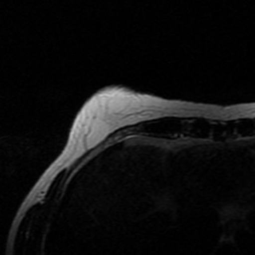 File:Breast lipoma and cancer (Radiopaedia 15118-14995 Axial T2 29).jpg