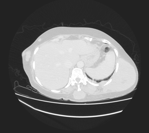 Breast metastases from facial malignant melanoma (Radiopaedia 60316-67975 Axial lung window 107).jpg