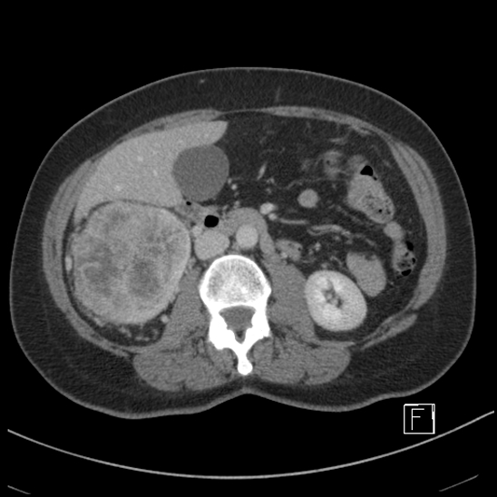 Breast metastases from renal cell cancer (Radiopaedia 79220-92225 C 46).jpg