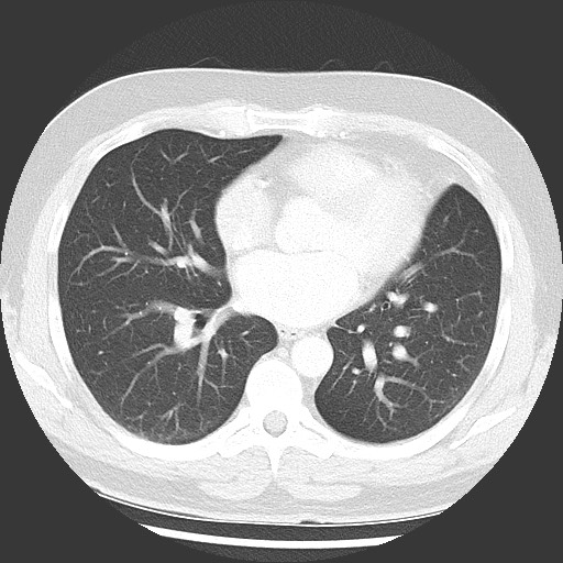 Bronchial carcinoid tumor (Radiopaedia 67377-76764 Axial lung window 37).jpg