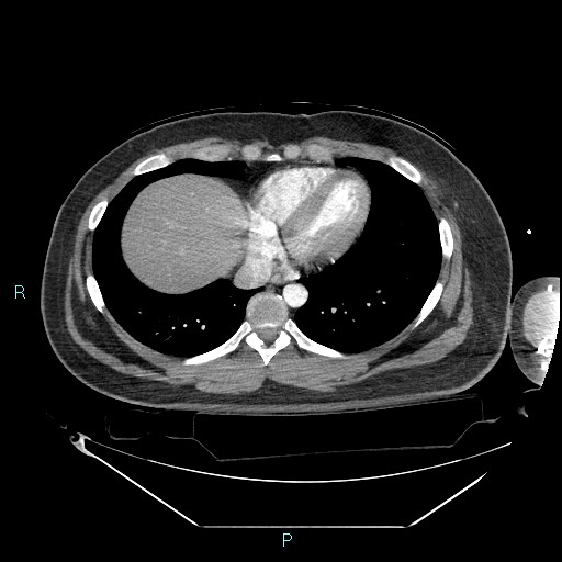 Bronchial carcinoid tumor (Radiopaedia 78272-90870 B 88).jpg