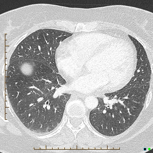File:Bronchial diverticula (Radiopaedia 79512-92676 Axial lung window 126).jpg