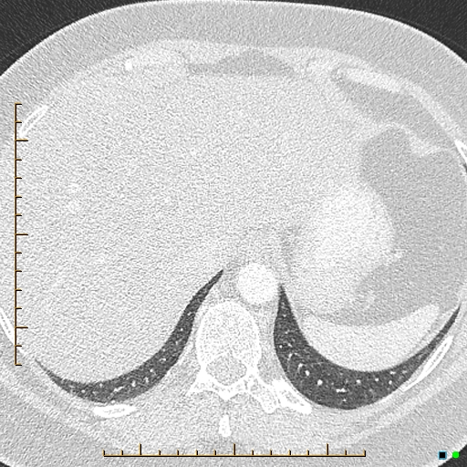 Bronchial diverticula (Radiopaedia 79512-92676 Axial lung window 187).jpg