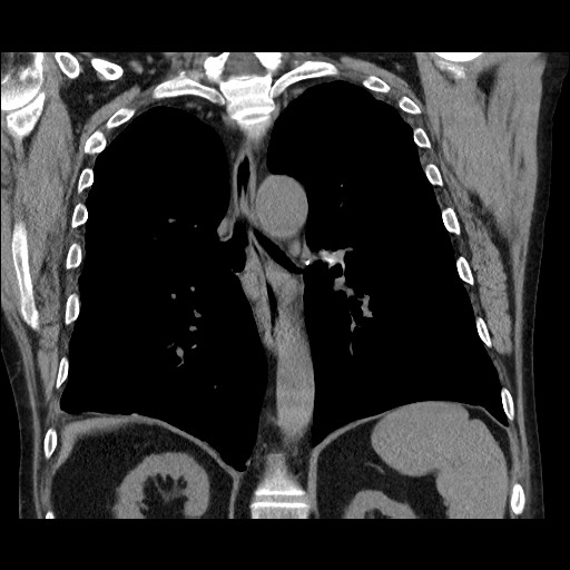 Bronchial stenosis - lung transplant (Radiopaedia 73133-83848 Coronal non-contrast 42).jpg