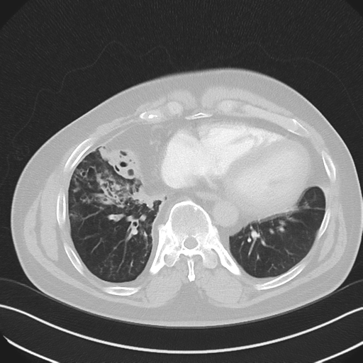 Bronchiectasis (Radiopaedia 39385-41666 Axial lung window 46).png