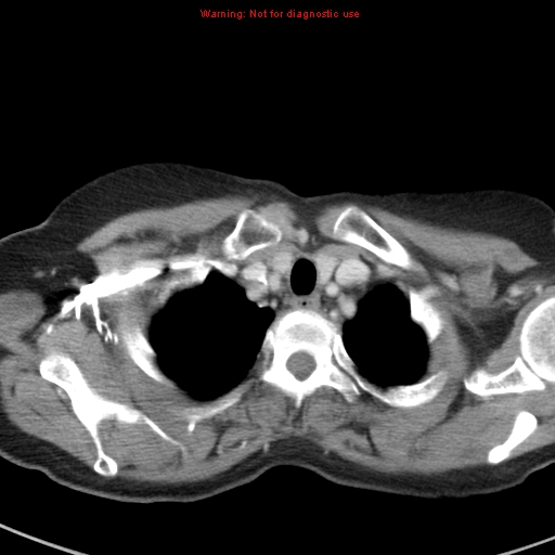 File:Bronchoalveolar carcinoma (BAC) (Radiopaedia 13436-13392 B 6).jpg
