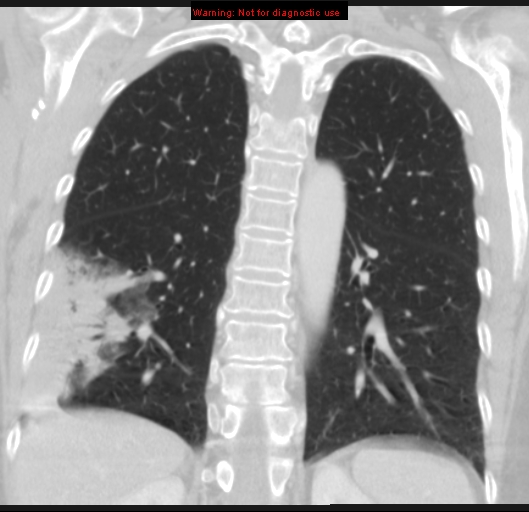 Bronchoalveolar carcinoma (BAC) (Radiopaedia 13436-13392 Coronal lung window 41).jpg