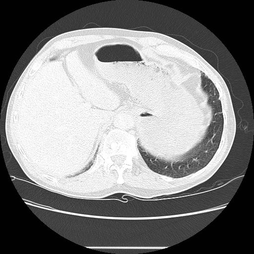 Bronchocele (Radiopaedia 17097-16795 Axial lung window 106).jpg