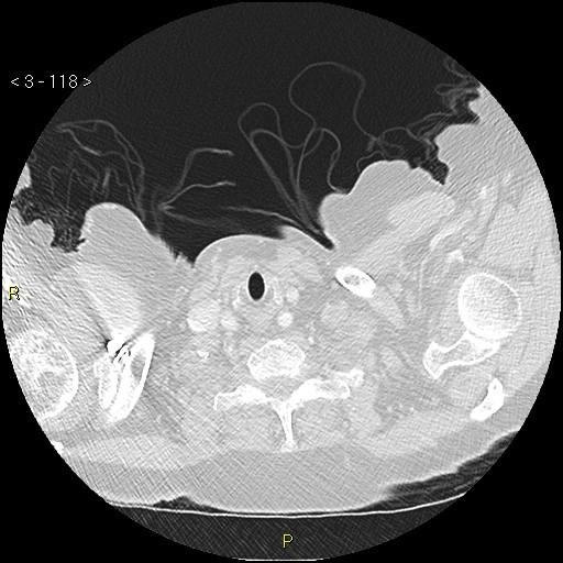 Bronchogenic carcinoma as an incidental finding (Radiopaedia 16453-16130 Axial lung window 118).jpg