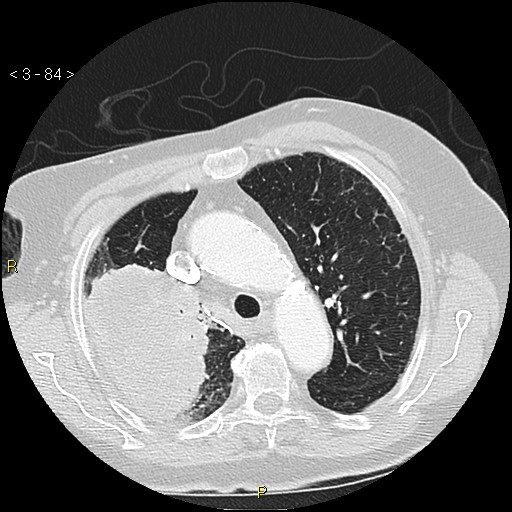 Bronchogenic carcinoma as an incidental finding (Radiopaedia 16453-16130 Axial lung window 84).jpg