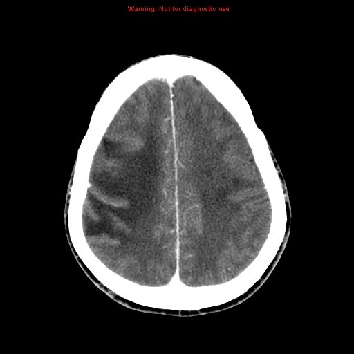 File:Bronchogenic carcinoma brain metastasis (Radiopaedia 9286-9970 B 22).jpg