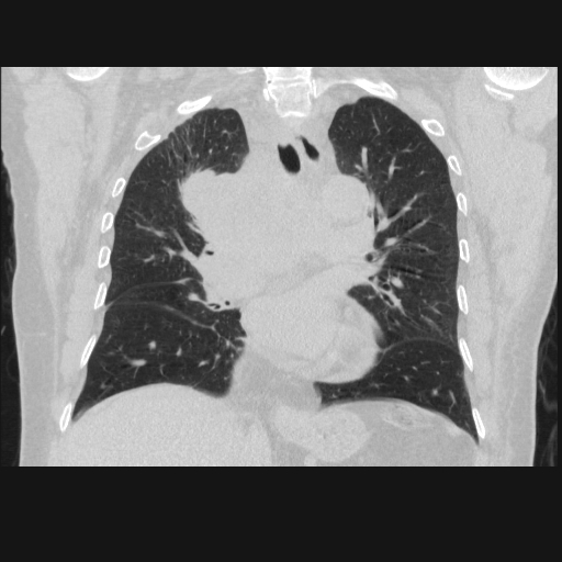 File:Bronchogenic carcinoma with metastatic lymphadenopathy (Radiopaedia 37671-39569 Coronal lung window 25).jpg