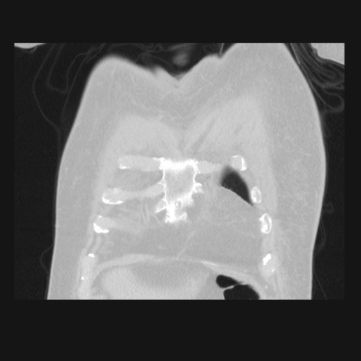 File:Bronchogenic carcinoma with metastatic lymphadenopathy (Radiopaedia 37671-39569 Coronal lung window 6).jpg