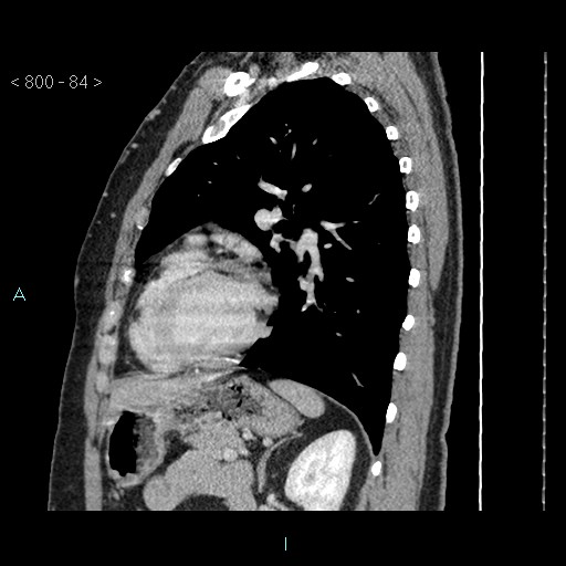 File:Bronchogenic cyst - posterior mediastinal (Radiopaedia 43885-47364 B 55).jpg