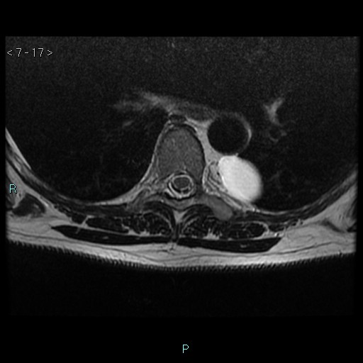 File:Bronchogenic cyst - posterior mediastinal (Radiopaedia 43885-47365 Axial T2 17).jpg