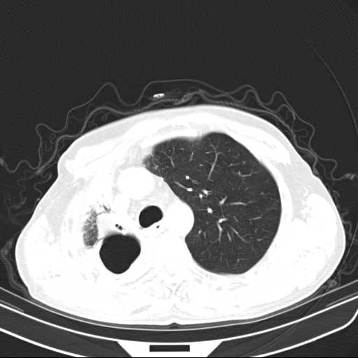 Bronchopleural fistula - postoperative complication (Radiopaedia 21020-20947 Axial lung window 17).jpg
