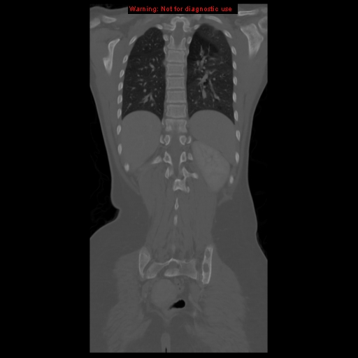 File:Brown tumor (Radiopaedia 12318-12596 D 50).jpg