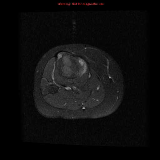File:Brown tumor (Radiopaedia 12318-12597 Axial T1 C+ fat sat 17).jpg
