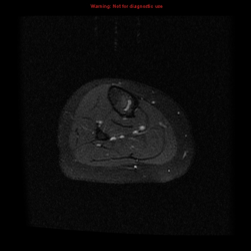 File:Brown tumor (Radiopaedia 12318-12597 Axial T1 C+ fat sat 28).jpg