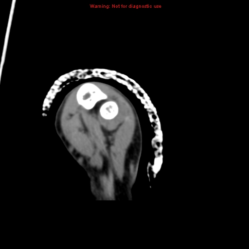 File:Brown tumor (Radiopaedia 12460-12694 Axial non-contrast 125).jpg