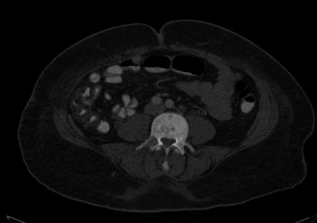 Brown tumors compressing the spinal cord (Radiopaedia 68442-77988 G 75).jpg