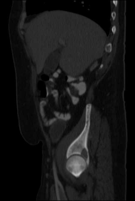 Brown tumors compressing the spinal cord (Radiopaedia 68442-77988 H 16).jpg