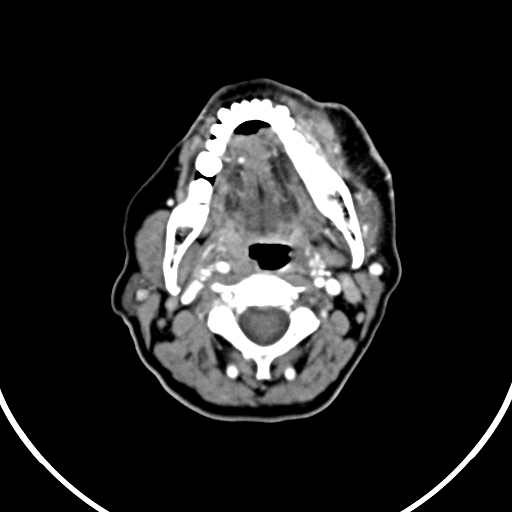 File:Buccal squamous cell carcinoma (Radiopaedia 8520-9346 A 21).jpg
