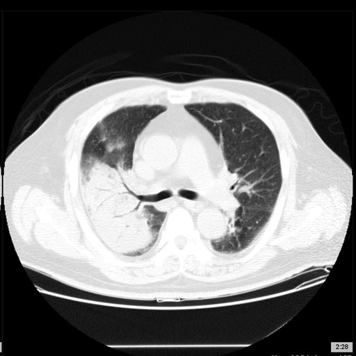 File:Bulging fissure sign of lobar consolidation (Radiopaedia 11266-62495 Axial lung window 1).jpg