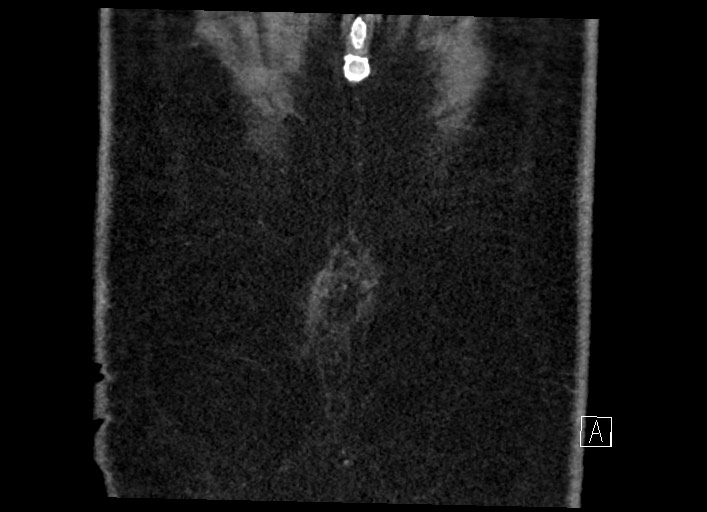 Buried bumper syndrome - gastrostomy tube (Radiopaedia 63843-72577 Coronal Inject 139).jpg