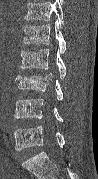 Burst fracture (Radiopaedia 53373-59357 Sagittal bone window 42).jpg