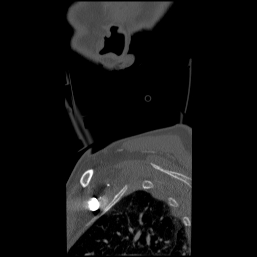 File:C1 anterior arch (plough) fracture - type 1 (Radiopaedia 76181-87720 Sagittal bone window 2).jpg