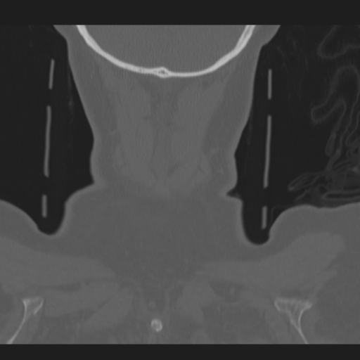 C2 fracture (Radiopaedia 34091-35341 Coronal bone window 61).png