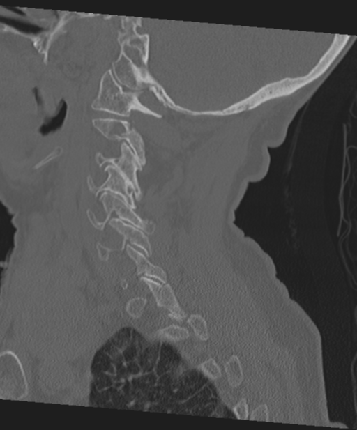 C2 fracture with vertebral artery dissection (Radiopaedia 37378-39199 Sagittal bone window 53).png