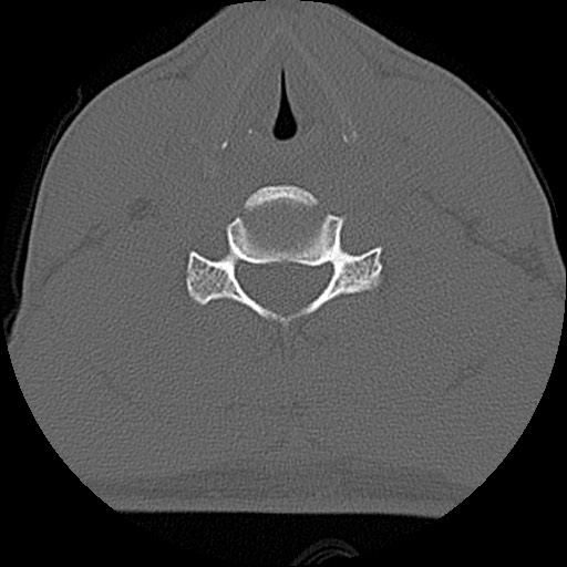 File:C5 facet fracture (Radiopaedia 58374-65499 Axial bone window 59).jpg