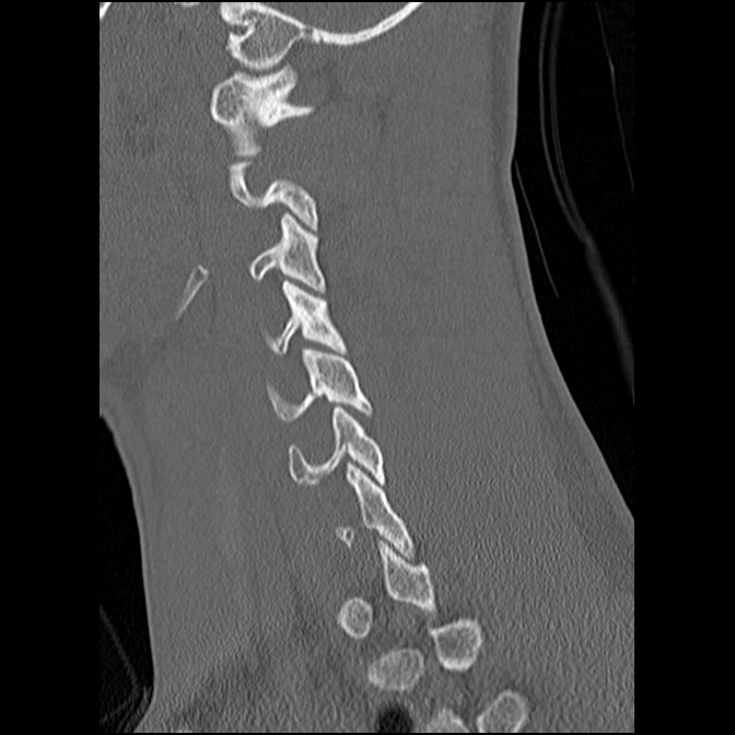C5 facet fracture (Radiopaedia 58374-65499 Sagittal bone window 26).jpg