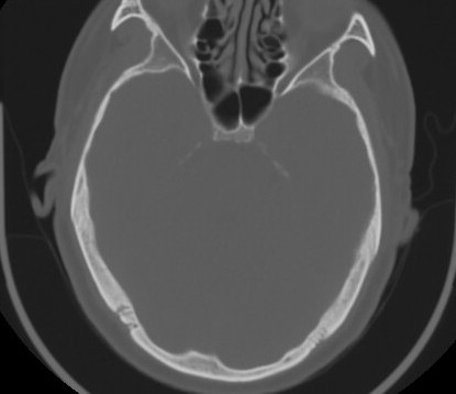 C7 laminar fracture and Klippel-Feil syndrome (Radiopaedia 86710-102850 Axial bone window 6).jpg