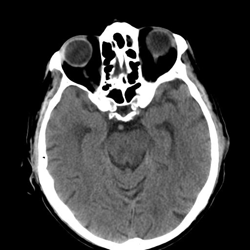 File:CNS lymphoma (Radiopaedia 36983-38639 Axial non-contrast 16).png