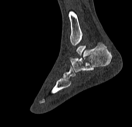 Calcaneal fracture - Sanders type 4 (Radiopaedia 90179-107370 Sagittal bone window 65).jpg