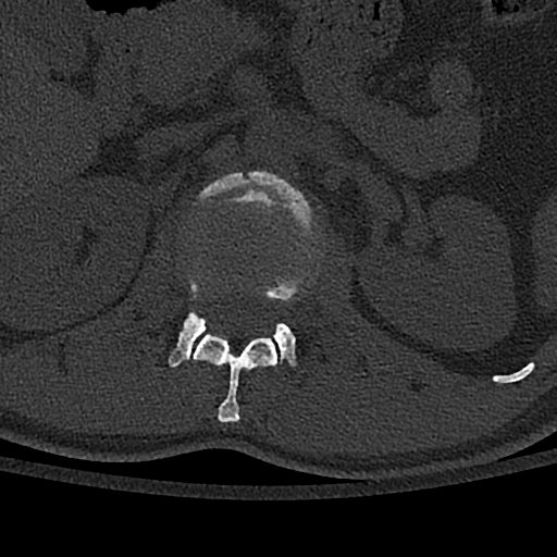 Calcaneal fractures with associated L2 burst fracture (Radiopaedia 71671-82493 Axial bone window 23).jpg