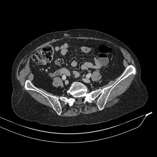 Calcified adrenal glands and Spigelian hernia (Radiopaedia 49741-54988 A 158).jpg