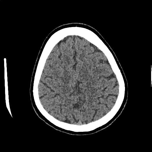 Calcified cerebral hydatid cyst (Radiopaedia 65603-74717 Axial non-contrast 62).jpg