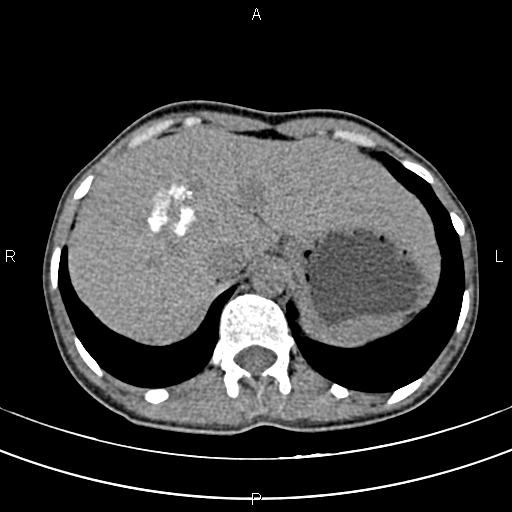 File:Calcified hepatic hydatid cyst (Radiopaedia 83870-99072 Axial non-contrast 31).jpg